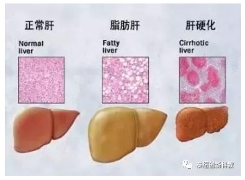 正常肝脏与脂肪肝的区别