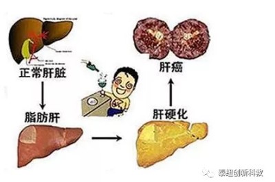肝癌的形成过程